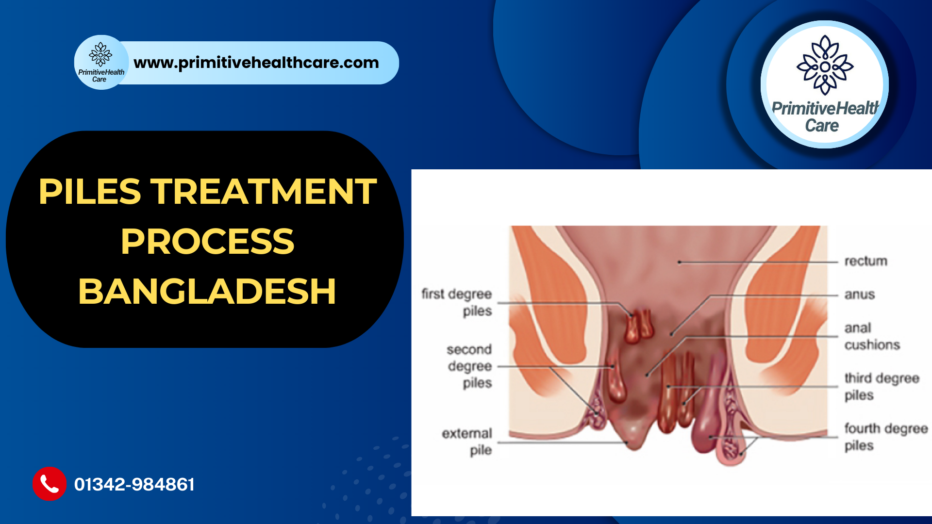 Piles Treatment Process Bangladesh